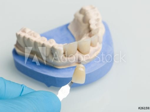 Porcelain Veneers