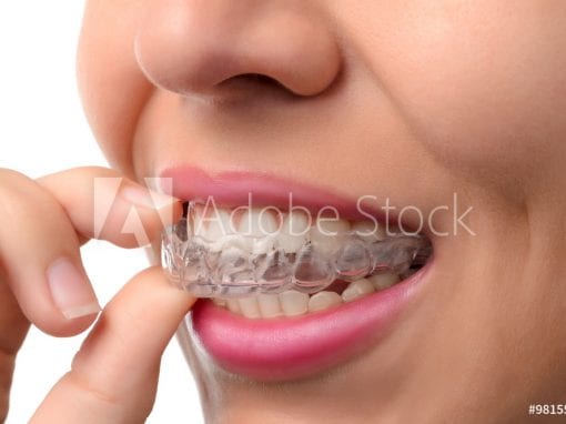 Short Term Adult Orthodontics
