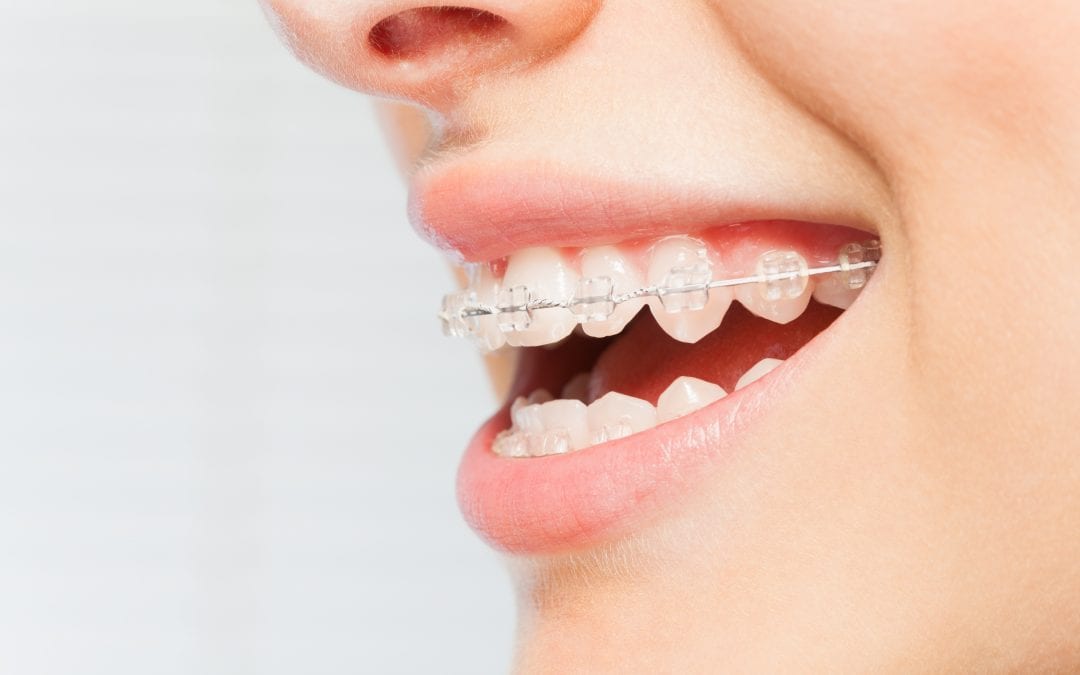 Quick Straight Teeth