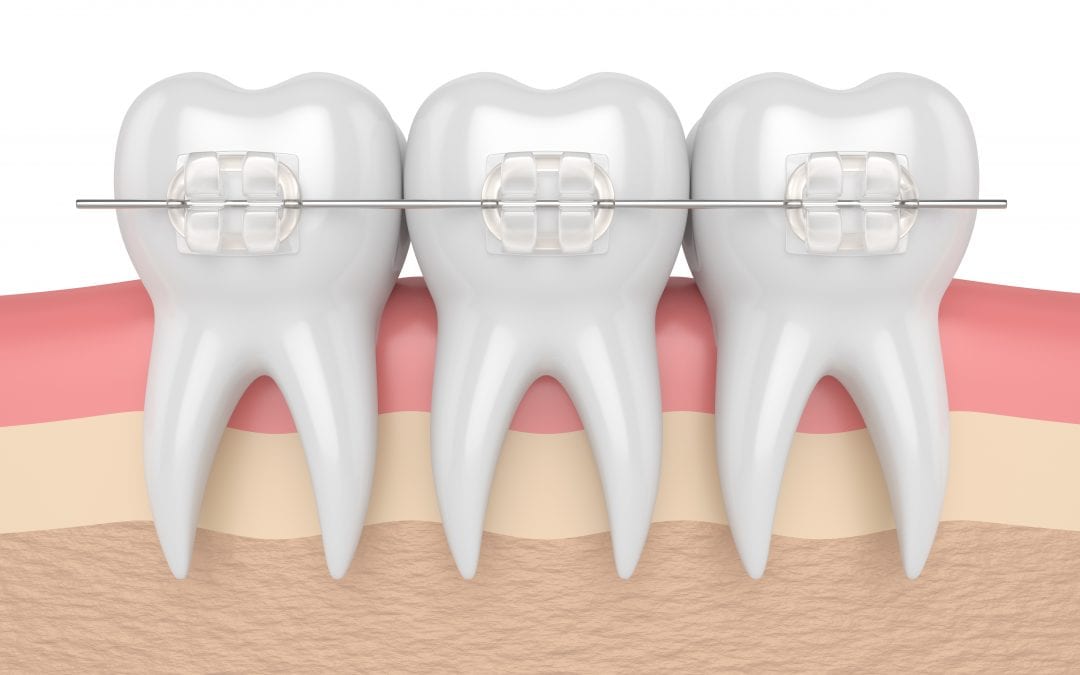 Short Term Adult Orthodontics