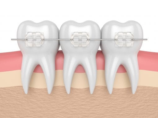 Short Term Adult Orthodontics