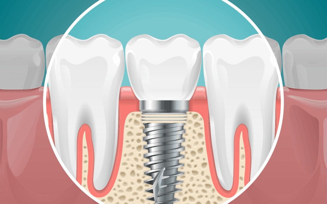 Dental Implants