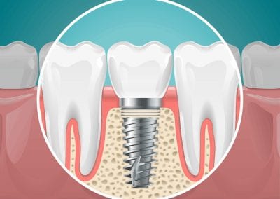 Dental Implants