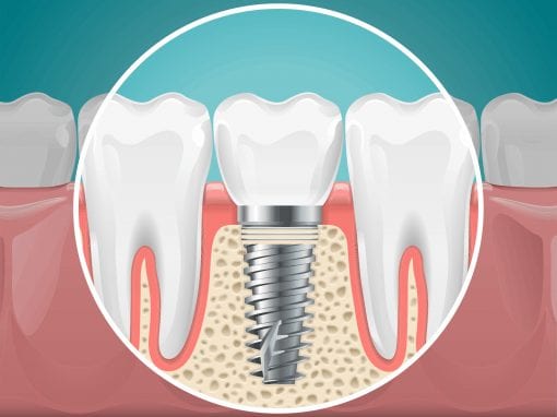 Dental Implants