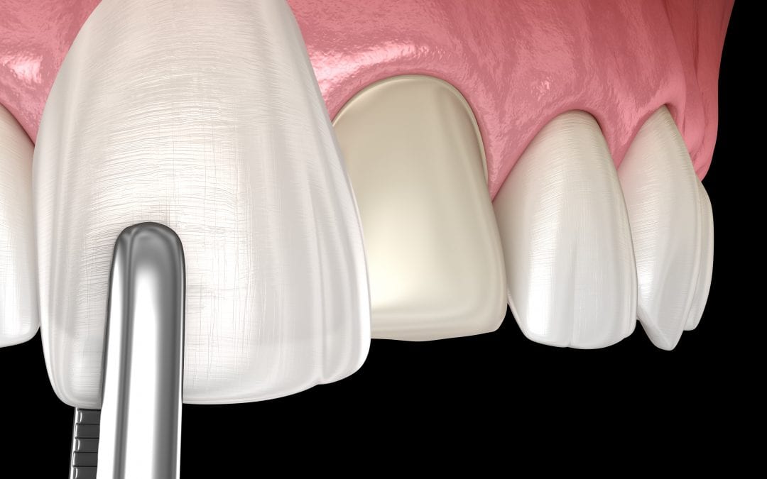 Porcelain Veneers