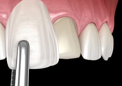 Porcelain Veneers