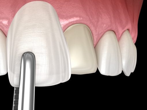 Porcelain Veneers